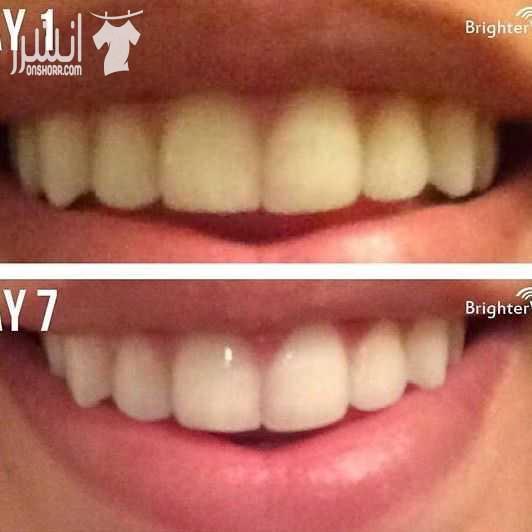 ❤️جهاز تبييض الاسنان المنزلى بالليزر❤️ سعروو 13 دينار والتوصيل مجاني 0780036355   تخلص من آثار التدخين والقهوه نهائيا خلال اسبوع بس