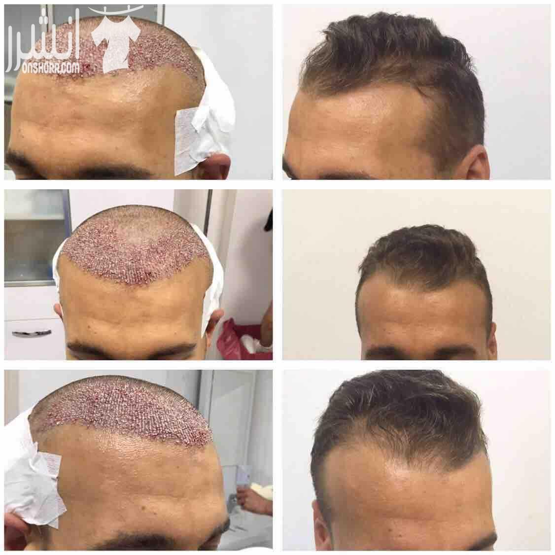 عروض مميزه لزراعة الشعر في اسطنبول تركيا