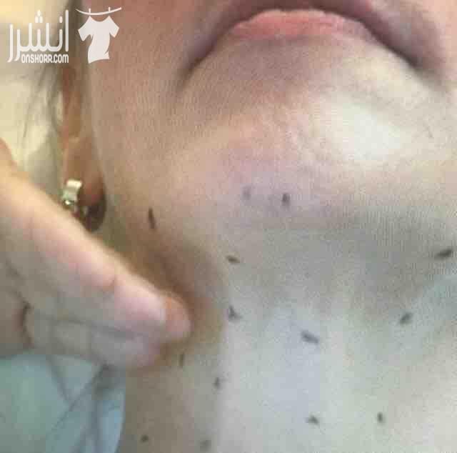 عروض علي جلسات اليزر   وجلسات الميزو  والبلازما