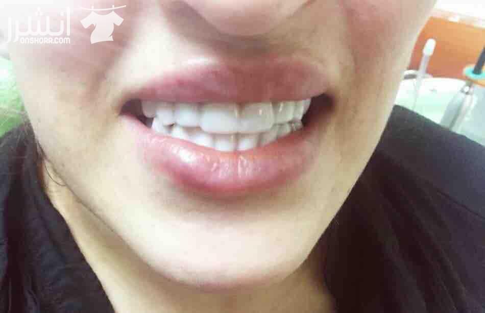 ????Snap On Smile ???? فـقـط فـي جلـستين ???????? احصلو على ابتسامة المشاهير (ابتسامة هوليوود) ???????????????? قشور رقيقة و قوية تغطي العيوب الموجوده بالاسنان الحل الامثل لتظهر بإبتسامة خاليه من...