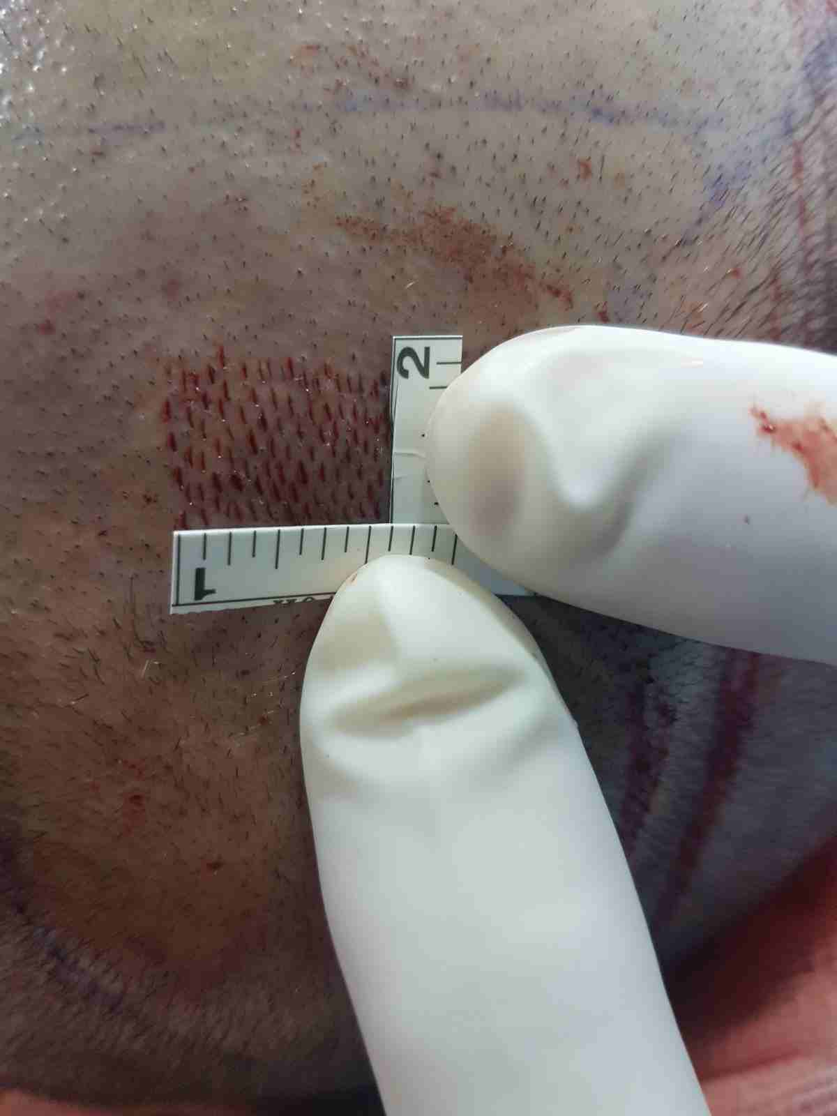 زراعة الشعر باسطنبول                                            


	 				لا تنسَ أنك شاهدت هذا الإعلان في عنكبوت            
	 				
                            عملية زراعة الشعر الآن مضمونة وناجحة...