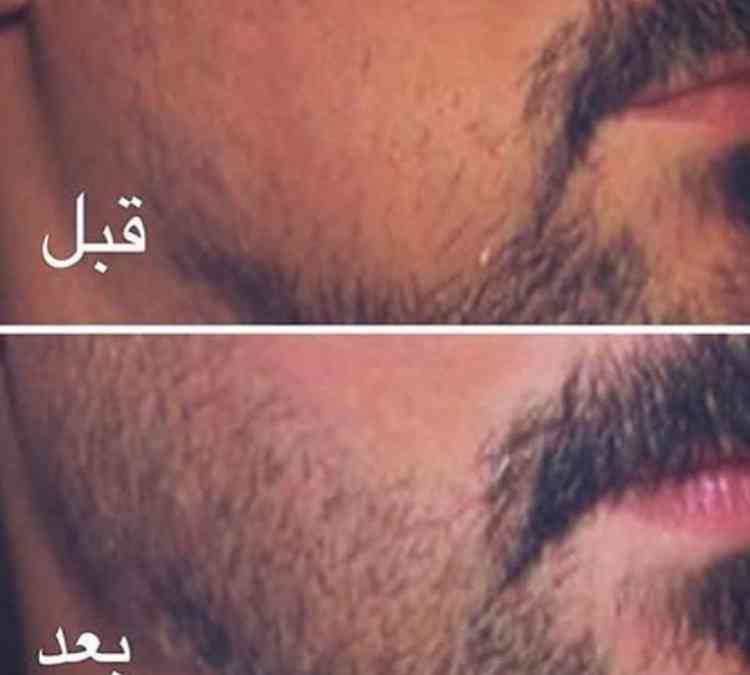 زيتين لمعالجة الشعر زيت الصبار وزيت الاعشاب
لا تنسَ أنك شاهدت هذا الإعلان في عنكبوت
زيت الصبا...