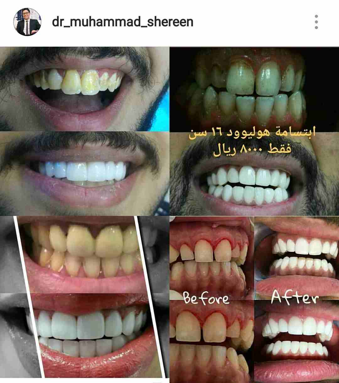 ابتسامة المشاهير فقط 7999 ريال                                            


	 				لا تنسَ أنك شاهدت هذا الإعلان في عنكبوت            
	 				
                            الحشوات و التنظيف مجانا و...
