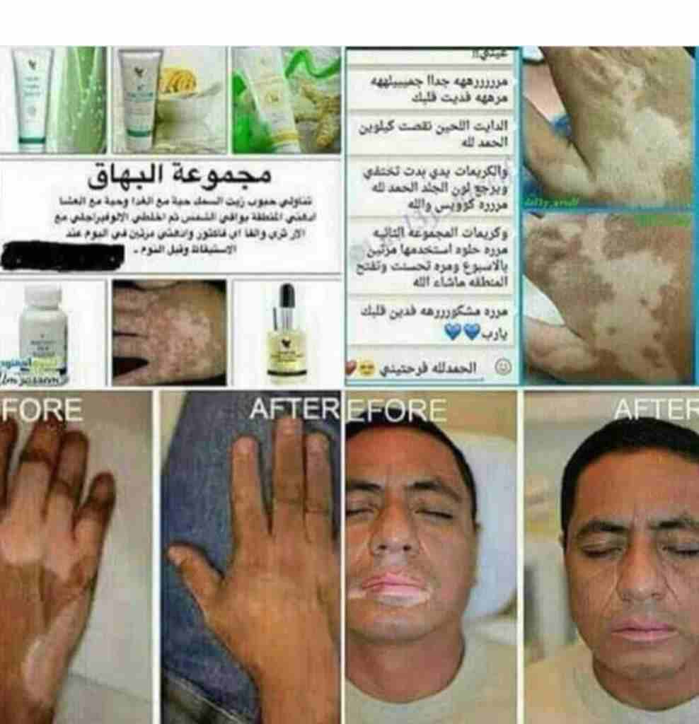 منتجات عنايه شخصيه طبيعيه 100 ٪                                            


	 				لا تنسَ أنك شاهدت هذا الإعلان في عنكبوت            
	 				
                            منتجات وعلاجات للدوالي وا...