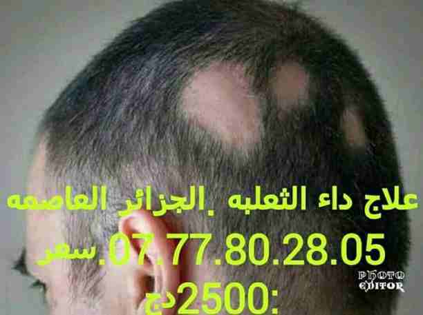 علاج داء الثعلبه 
نتائج مدهشه بشهاده الزبائن