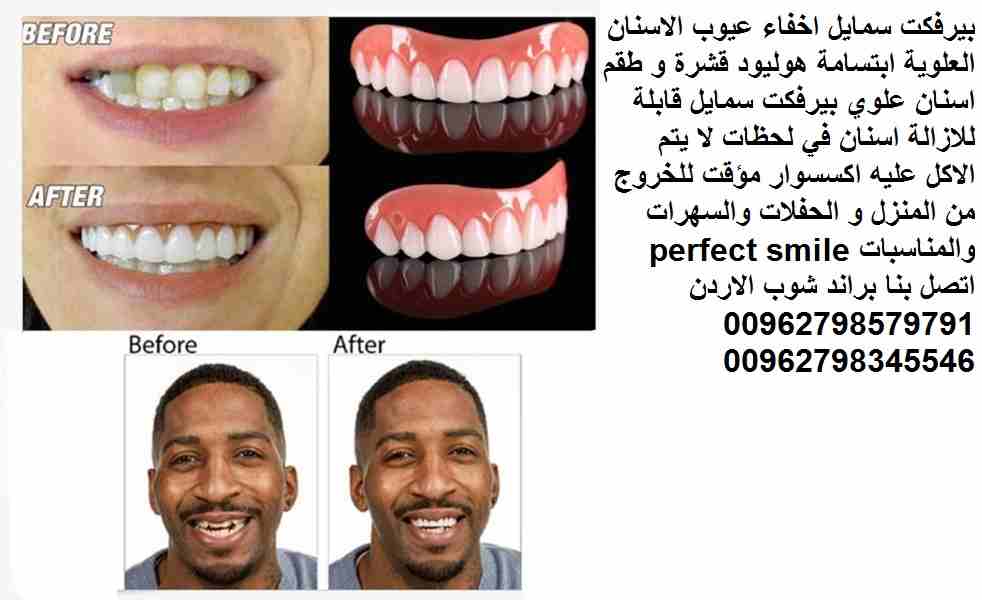 اسنان علوية القشرة المذهلة والقابلة للإزالة التي تمنحك على الفور مظهر الأسنان المثالية التي ستفخر بابتسامتها. السر؟ الابتسامة الكمال بيرفكت سمايل اخفاء عيوب الاسنان العلوية ابتسامة هوليود قشرة و طقم ا...