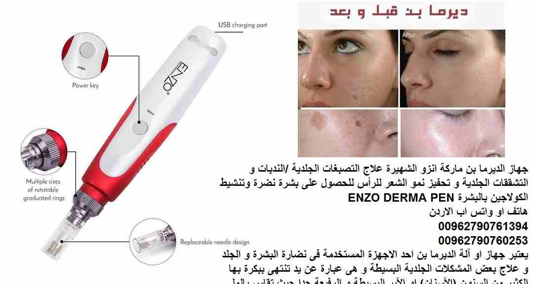 علاج التصبغات الجلدية ... التشققات الجلدية / علاج الندبات جهاز الديرما بن ماركة اينزو الشهيرة علاج التصبغات الجلدية /الندبات و التشققات الجلدية و تحفيز نمو الشعر للرأس للحصول على بشرة نضرة وتنشيط الكو...