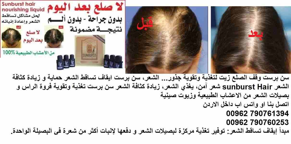 علاج تساقط الشعر | اعادة نمو الشعر؟ سن برست وقف الصلع زيت لتغذية وتقوية جذور( علاج الصلع ) ... الشعر، سن برست ايقاف تساقط الشعر حماية و زيادة كثافة الشعر sunburst Hair شعر آمن، يغذي الشعر، زيادة كثاف...