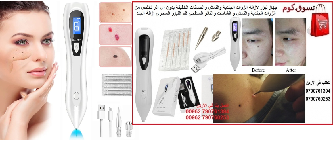 الافضل لازالة الزوائد الجلدية من الجسم ازالة النمش والحسنات الخفيفة بدون اي اثر تخلص من الزوائد الجلدية